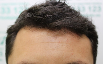 El injerto de pelo, no sólo en la cabeza. Otras aplicaciones efectivas del trasplante capilar.